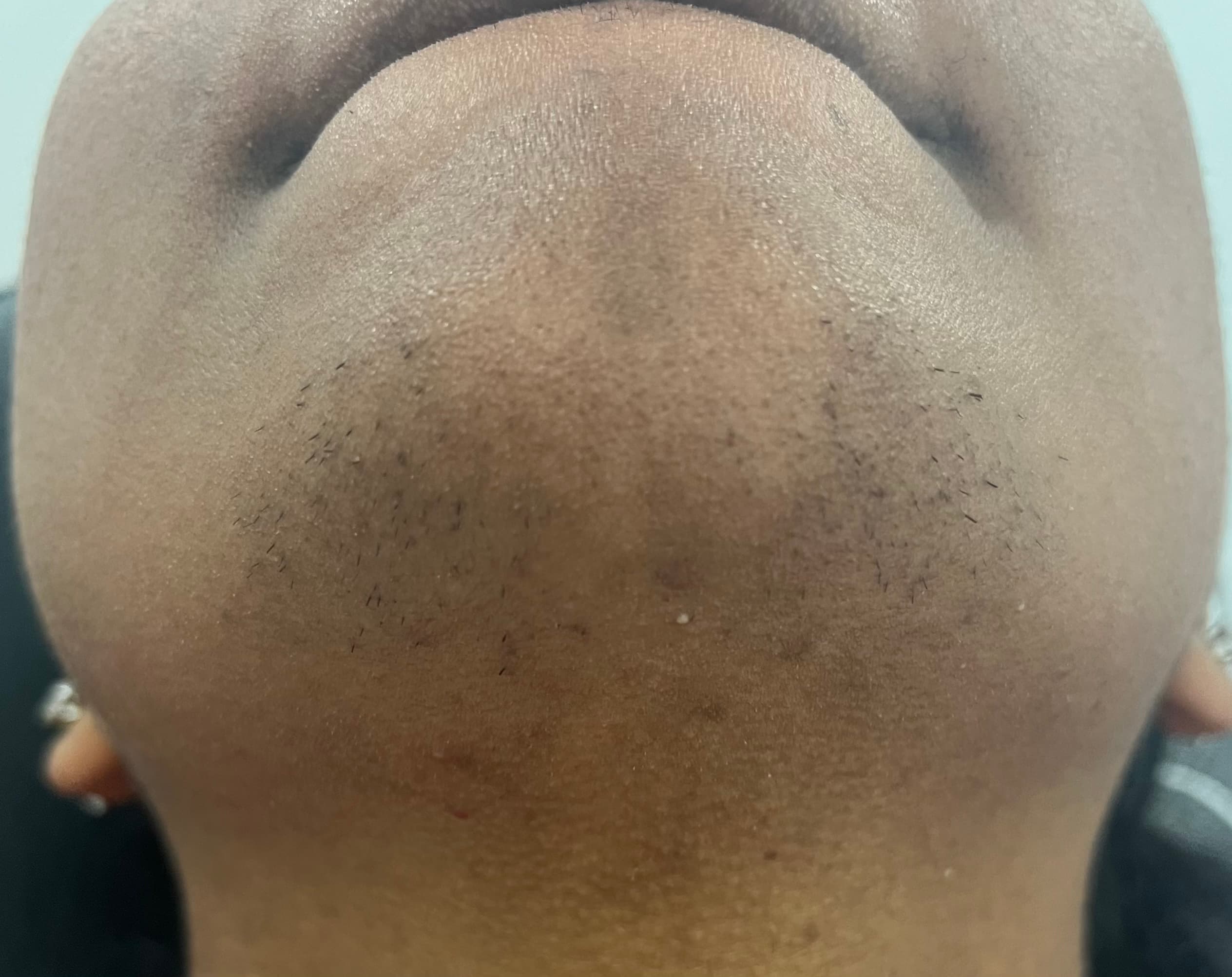 Chin - Hair Removal — before