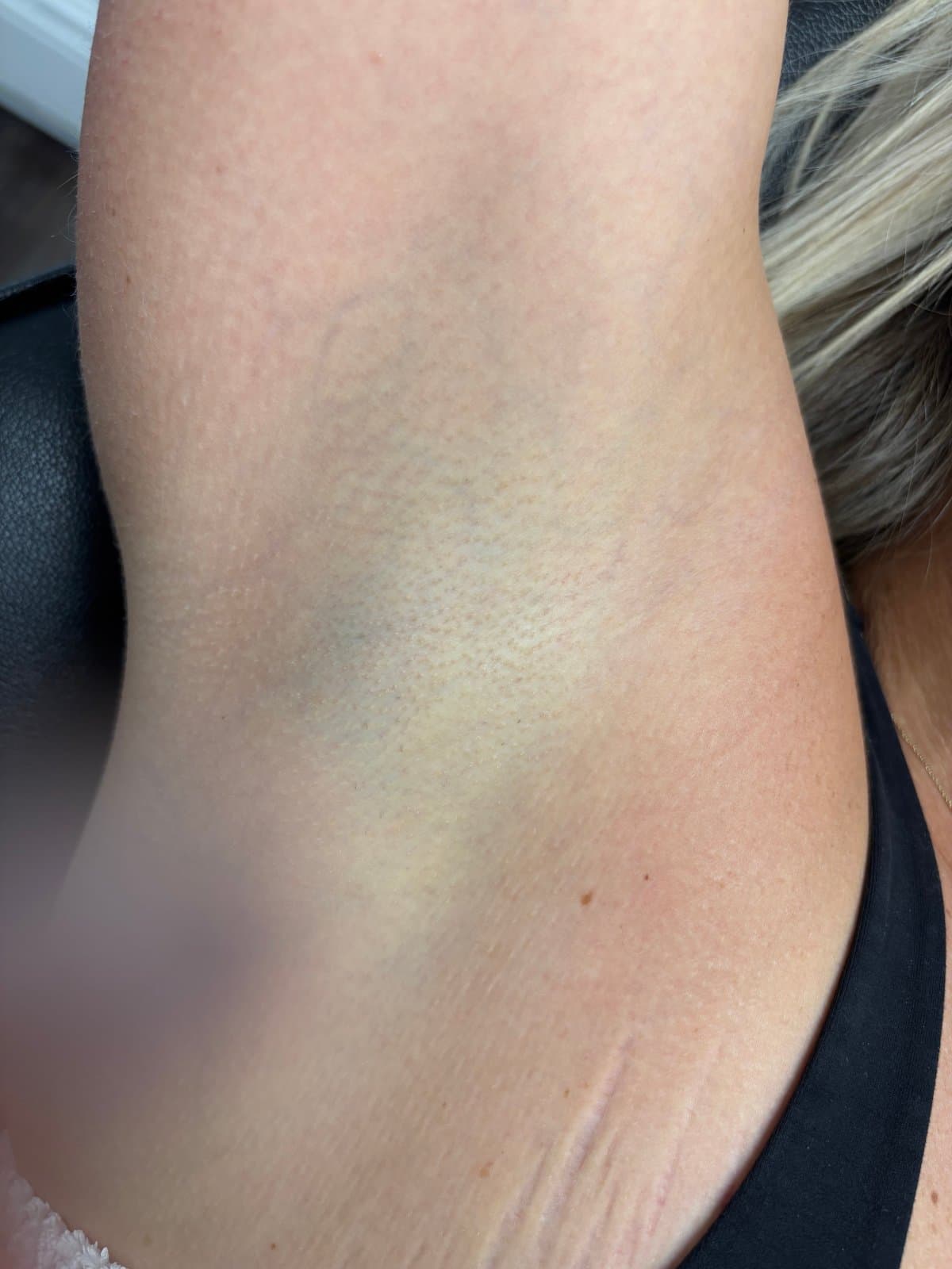 Underarms — after